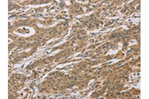 The image on the left is immunohistochemistry of paraffin-embedded Human gastric cancer tissue using ABIN7129118(CYFIP2 Antibody) at dilution 1/25, on the right is treated with fusion protein. (CYFIP2 抗体)