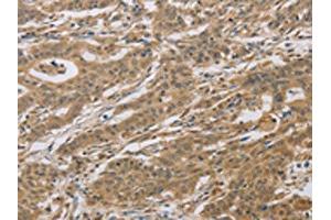 The image on the left is immunohistochemistry of paraffin-embedded Human gastric cancer tissue using ABIN7129118(CYFIP2 Antibody) at dilution 1/25, on the right is treated with fusion protein. (CYFIP2 抗体)