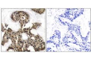 Immunohistochemical analysis of paraffin-embedded human breast carcinoma tissue using 4E-BP1 (Ab-45) antibody (E021216). (eIF4EBP1 抗体)