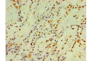 Immunohistochemistry of paraffin-embedded human breast cancer using ABIN7149253 at dilution of 1:100 (CYP2J2 抗体  (AA 328-502))