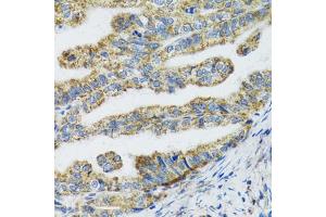Immunohistochemistry of paraffin-embedded human gastric cancer using TXN2 antibody (ABIN2560616) at dilution of 1:100 (40x lens). (TXN2 抗体)