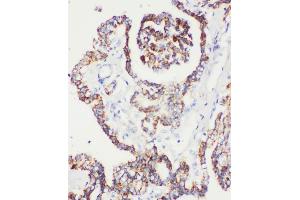 Anti-Peroxiredoxin 5 antibody, IHC(P) IHC(P): Human Prostatic Cancer Tissue (Peroxiredoxin 5 抗体  (C-Term))