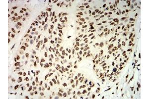 Immunohistochemical analysis of paraffin-embedded esophageal cancer tissues using UHRF1 mouse mAb with DAB staining. (UHRF1 抗体  (AA 616-755))