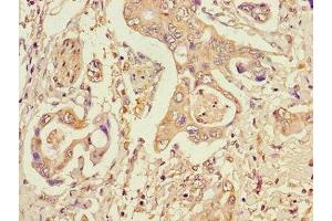 Immunohistochemistry of paraffin-embedded human pancreatic cancer using ABIN7150603 at dilution of 1:100 (STT3A 抗体  (AA 39-114))