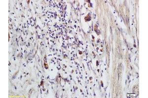 Formalin-fixed and paraffin embedded human colon carcinoma labeled with Anti-CCP Polyclonal Antibody, Unconjugated (ABIN736971) at 1:200 followed by conjugation to the secondary antibody and DAB staining (CRYGD 抗体)
