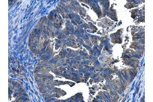 IHC-P Image CCDC83 antibody [N1C2] detects CCDC83 protein at cytoplasm and nucleus in human endometrial cancer by immunohistochemical analysis. (CCDC83 抗体)