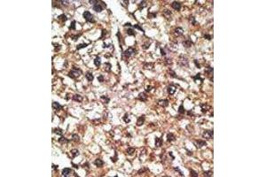 Formalin-fixed and paraffin-embedded human cancer tissue reacted with the primary antibody, which was peroxidase-conjugated to the secondary antibody, followed by AEC staining. (PINK1 抗体  (N-Term))