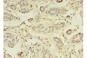 Immunohistochemistry of paraffin-embedded human breast cancer using ABIN7176199 at dilution of 1:100 (ZNF266 抗体  (AA 257-549))