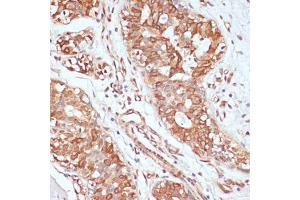 Immunohistochemistry of paraffin-embedded human mammary cancer using PTPRN2 antibody (ABIN7269710) at dilution of 1:100 (40x lens). (PTPRN2 抗体  (AA 22-242))