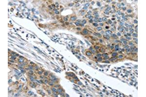 The image on the left is immunohistochemistry of paraffin-embedded Human esophagus cancer tissue using ABIN7131406(TMPRSS5 Antibody) at dilution 1/25, on the right is treated with fusion protein. (TMPRSS5 抗体)