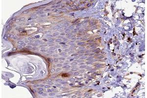 ABIN6267491 at 1/100 staining human Skin cancer tissue sections by IHC-P. (VEGFR2/CD309 抗体  (pTyr1214))