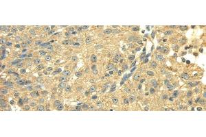 Immunohistochemistry of paraffin-embedded Human breast cancer using SDHA Polyclonal Antibody at dilution of 1/40 (SDHA 抗体)