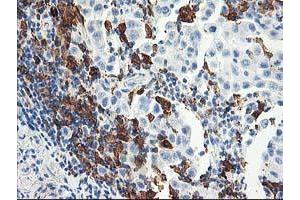 Immunohistochemical staining of paraffin-embedded Carcinoma of Human lung tissue using anti-GBP1 mouse monoclonal antibody. (GBP1 抗体)