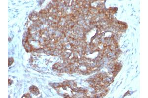 Formalin-fixed, paraffin-embedded human Ovarian Carcinoma stained with pS2 Monoclonal Antibody (SPM313). (TFF1 抗体  (AA 57-84))