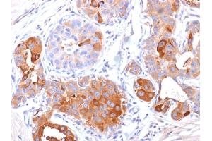Formalin-fixed, paraffin-embedded human Breast Carcinoma stained with GCDFP-15 Mouse Monoclonal Antibody (PIP/1571). (PIP 抗体  (AA 41-146))