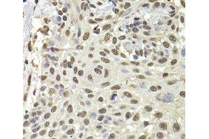 Immunohistochemistry of paraffin-embedded Human well-differentiated squamous skin carcinoma using PUF60 Polyclonal Antibody at dilution of 1:100 (40x lens). (PUF60 抗体)