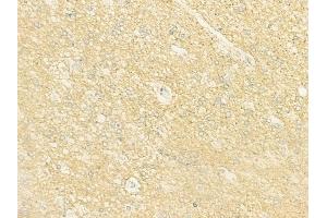 ABIN6262899 and ABIN6273003 at 1/100 staining human glioblastoma by IHC-P. (L2HGDH 抗体  (Internal Region))