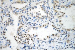 Immunohistochemistry was performed on paraffin-embedded human lung adenocarcinoma using MAP2K3 antibody (ABIN7799465), 1:200).