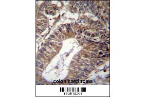 GCC1 Antibody immunohistochemistry analysis in formalin fixed and paraffin embedded human colon carcinoma followed by peroxidase conjugation of the secondary antibody and DAB staining. (GCC1 抗体  (C-Term))