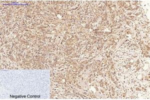 Immunohistochemical analysis of paraffin-embedded human breast cancer tissue. (MLKL 抗体  (pSer358))