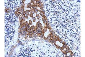 IHC-P Image Immunohistochemical analysis of paraffin-embedded human breast cancer, using IL1RAP, antibody at 1:500 dilution.