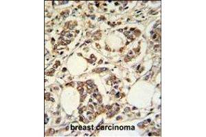 PIGM Antibody (C-term) (ABIN650949 and ABIN2840006) IHC analysis in formalin fixed and paraffin embedded breast carcinoma followed by peroxidase conjugation of the secondary antibody and DAB staining. (PIGM 抗体  (C-Term))