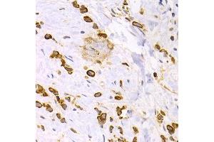 Immunohistochemistry of paraffin-embedded human stomach cancer using KRT15 antibody at dilution of 1:200 (400x lens). (KRT15 抗体)