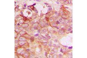 Immunohistochemical analysis of PIG3 staining in human breast cancer formalin fixed paraffin embedded tissue section. (MRPL41 抗体  (C-Term))
