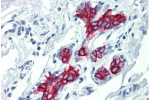 Human Breast (formalin-fixed, paraffin-embedded) stained with KRT19 antibody ABIN396943 at 10 ug/ml followed by biotinylated anti-mouse IgG secondary antibody ABIN481714, alkaline phosphatase-streptavidin and chromogen. (Cytokeratin 19 抗体)