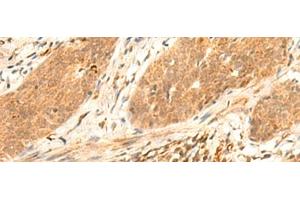 Immunohistochemistry of paraffin-embedded Human esophagus cancer tissue using HES7 Polyclonal Antibody at dilution of 1:25(x200)