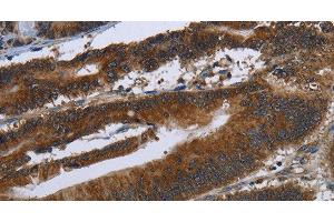 Immunohistochemistry of paraffin-embedded Human colon cancer tissue using ARHGEF12 Polyclonal Antibody at dilution 1:30 (ARHGEF12 抗体)