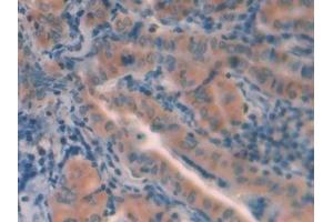 Detection of CTSL in Human Thyroid cancer Tissue using Polyclonal Antibody to Cathepsin L (CTSL) (Cathepsin L 抗体  (AA 114-288))