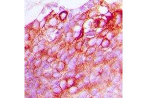 Immunohistochemical analysis of GPR170 staining in human breast cancer formalin fixed paraffin embedded tissue section. (OXER1 抗体)