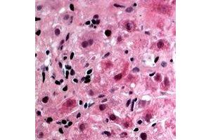 Immunohistochemical analysis of Glycerol Kinase 1 staining in human liver cancer formalin fixed paraffin embedded tissue section. (Glycerol Kinase 1 抗体  (N-Term))