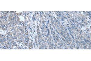 Immunohistochemistry of paraffin-embedded Human liver cancer tissue using ZC3HAV1 Polyclonal Antibody at dilution of 1:70(x200) (ZC3HAV1 抗体)