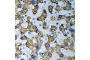 Immunohistochemical analysis of HADHA staining in human liver cancer formalin fixed paraffin embedded tissue section. (HADHA 抗体)