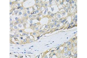 Immunohistochemistry of paraffin-embedded Human breast cancer using CD98 Polyclonal Antibody at dilution of 1:100 (40x lens).