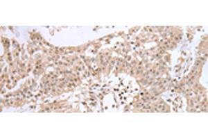 Immunohistochemistry of paraffin-embedded Human colorectal cancer tissue using UBE2I Polyclonal Antibody at dilution of 1:40(x200) (UBE2I 抗体)