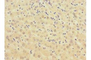 Immunohistochemistry of paraffin-embedded human liver cancer using ABIN7145876 at dilution of 1:100 (BTN1A1 抗体  (AA 27-210))