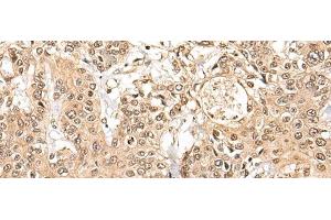 Immunohistochemistry of paraffin-embedded Human prost ate cancer tissue using NCAPH Polyclonal Antibody at dilution of 1:45(x200) (NCAPH 抗体)