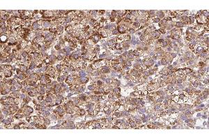 ABIN6272675 at 1/100 staining Human liver cancer tissue by IHC-P. (BAI2 抗体  (C-Term))
