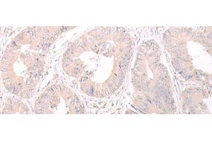 Immunohistochemistry of paraffin-embedded Human colorectal cancer tissue using FOXRED2 Polyclonal Antibody at dilution of 1:35(x200) (FOXRED2 抗体)