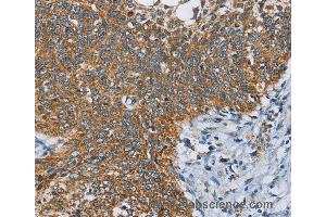 Immunohistochemistry of Human thyroid cancer using ANKHD1 Polyclonal Antibody at dilution of 1:40 (ANKHD1 抗体)