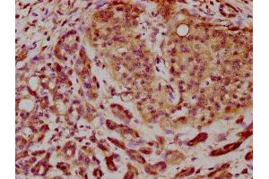 IHC image of ABIN7145792 diluted at 1:200 and staining in paraffin-embedded human pancreatic cancer performed on a Leica BondTM system. (BROX 抗体  (AA 288-409))