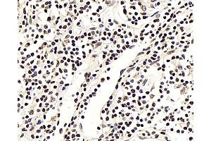 Immunohistochemistry analysis of paraffin-embedded human lung cancer using NFKBIB Polyclonal Antibody at dilution of 1:300. (NFKBIB 抗体)