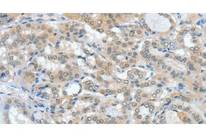 Immunohistochemistry of paraffin-embedded Human thyroid cancer tissue using ASH2L Polyclonal Antibody at dilution 1:60 (ASH2L 抗体)