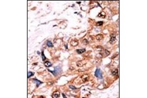 Formalin-fixed and paraffin-embedded human cancer tissue reacted with the primary antibody, which was peroxidase-conjugated to the secondary antibody, followed by AEC staining. (YES1/SRC (pTyr530) 抗体)