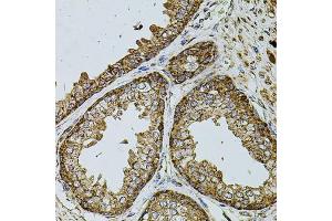 Immunohistochemistry of paraffin-embedded human prostate using UQCRC1 antibody (ABIN5971722) at dilution of 1/100 (40x lens). (UQCRC1 抗体)