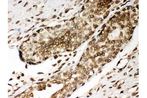 Anti- Lamin A Picoband antibody, IHC(P) IHC(P): Human Mammary Cancer Tissue (Lamin A/C 抗体  (AA 481-646))