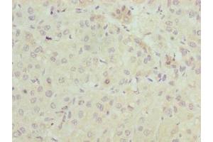Immunohistochemistry of paraffin-embedded human liver cancer using ABIN7151560 at dilution of 1:100 (ELOVL2 抗体  (AA 91-174))